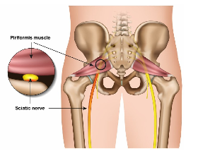 Piriformis sindrom: Uzrok boli u leđima i lažnog išijasa