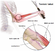 Sve što trebate znati o teniskom laktu (lateralnom epikondilitisu)