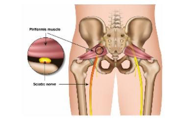 Piriformis sindrom: Uzrok boli u leđima i lažnog išijasa